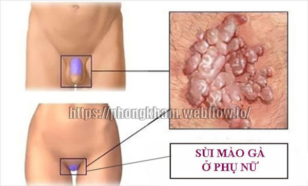 Chẩn đoán và điều trị sùi mào gà